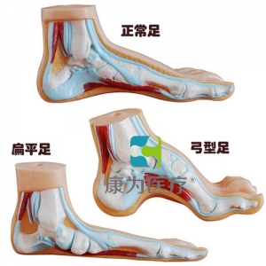 “康為醫(yī)療”正常足、扁平足、弓型足模型