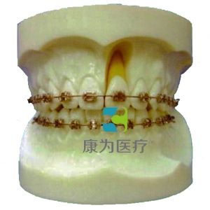 “康為醫(yī)療”帶方絲托槽的正畸示教模型