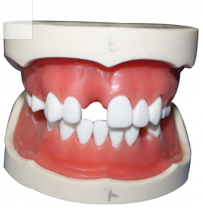 種植牙模型（含上、下頜）